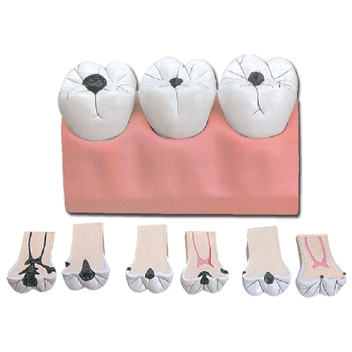 DENTAL CARIES - 7 PARTS - 4X