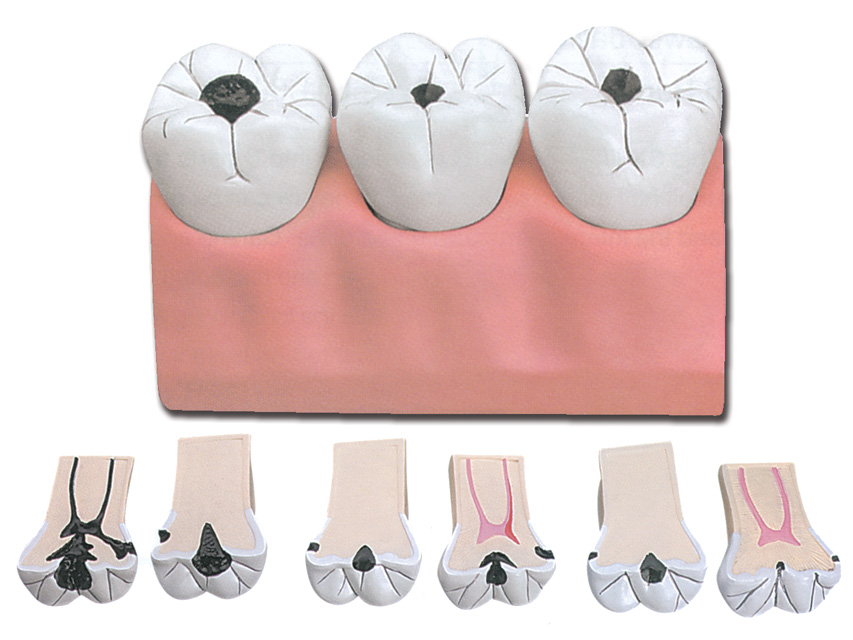 dental caries - 7 parts - 4x1