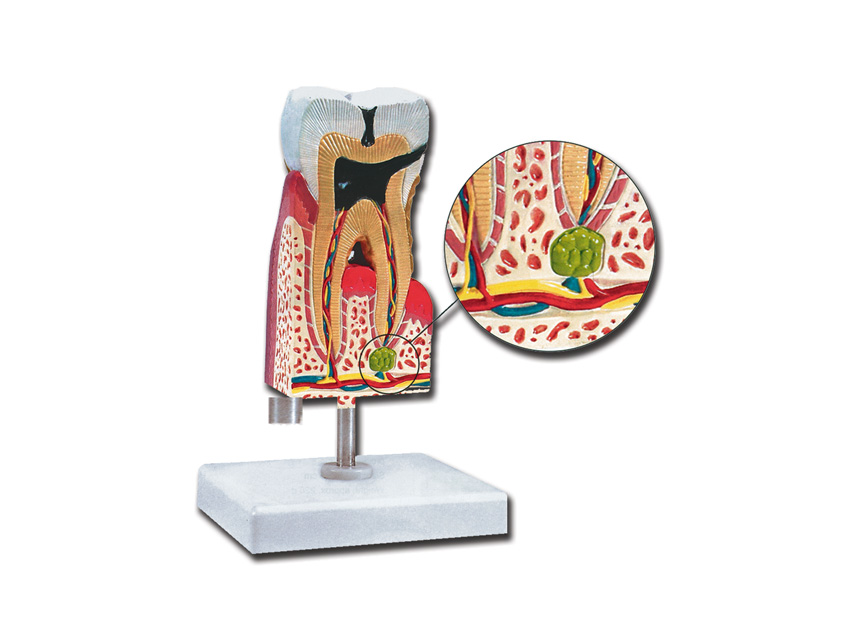 lower molar with caries - 10x1